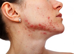 Traiter l’acné